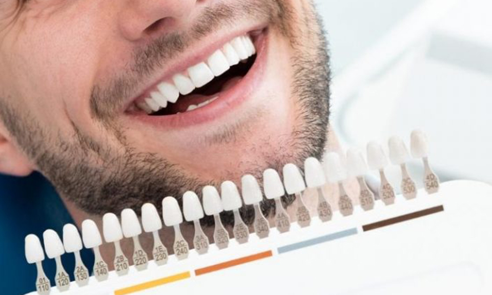 Smiling man having his tooth shade matched with a shade guide