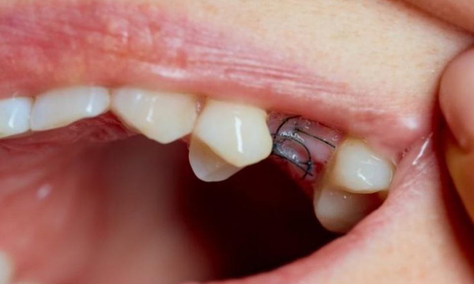 Close-up of healing gums with stitches after a tooth extraction