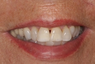 Patient smile after treatment