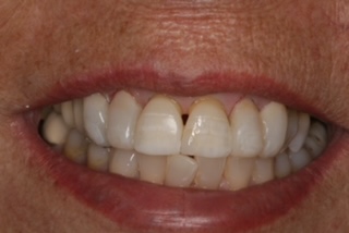 Patient smile before treatment
