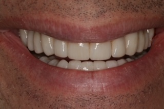 Patient smile after treatment