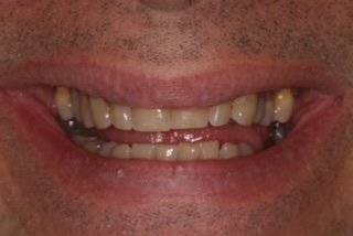 Patient smile before treatment
