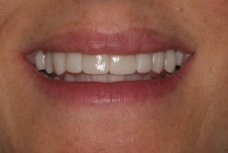 Patient smile after treatment
