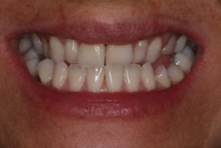 Patient smile before treatment
