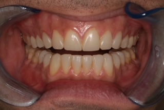 Patient smile before treatment